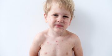 Chicken pox