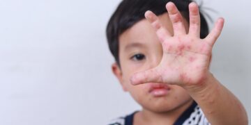 Hand, foot, and mouth disease