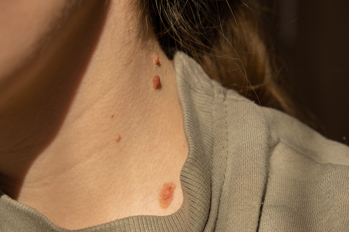 Melanoma