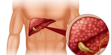 Pancreatic Cancer